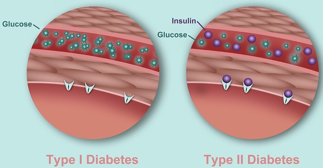 differenza-tra-diabete-di-tipo-1-e-diabete-di-tipo-2